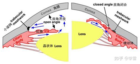 房角|原发性开角型青光眼